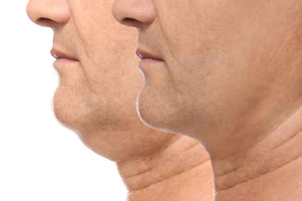 HIFU - Breakthrough in Anti - ageing 2 hifu results Paisley