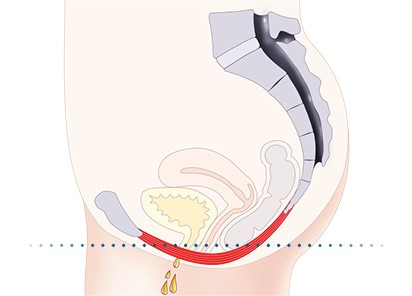 Pelvic-Floor Muscle Repair 5 Pelvic floor muscles Paisley