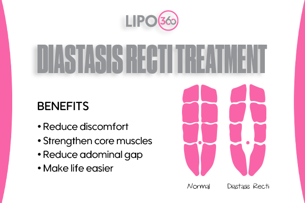 Revolutionising Muscle Repair: The Power of LIPO360 Body Sculpt Post-Injury 5 diastasis recti treatment Paisley