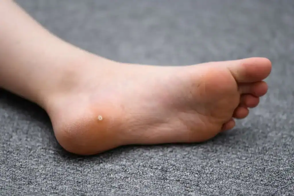 Cryotherapy For Warts And Also Verrucas 2 Image of verruca on the bottom of the foot that able to be treated with Cryotherapy Paisley