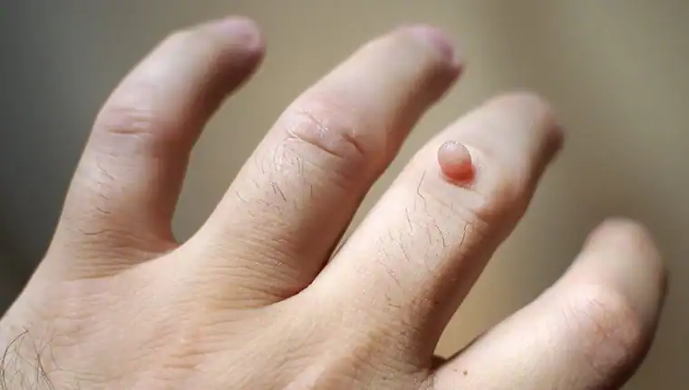 Image of blemish that Cryotherapy Paisley can remove with Lipo 360.