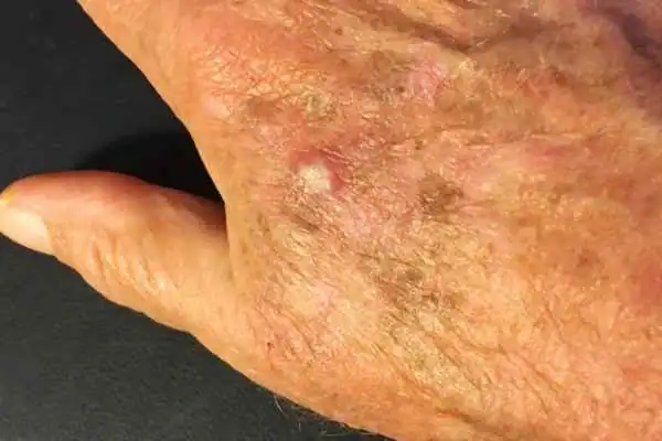 Image of Actinic keratoses Paisley on a person hand