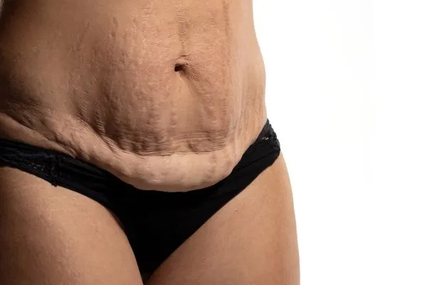 The Science of Skin Tightening 1 The science behind skin tightening Paisley picture of a woman's sagging skin on the stomach